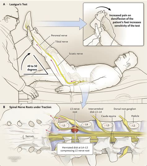 sciatic nerve compression test|slr test for sciatic nerve.